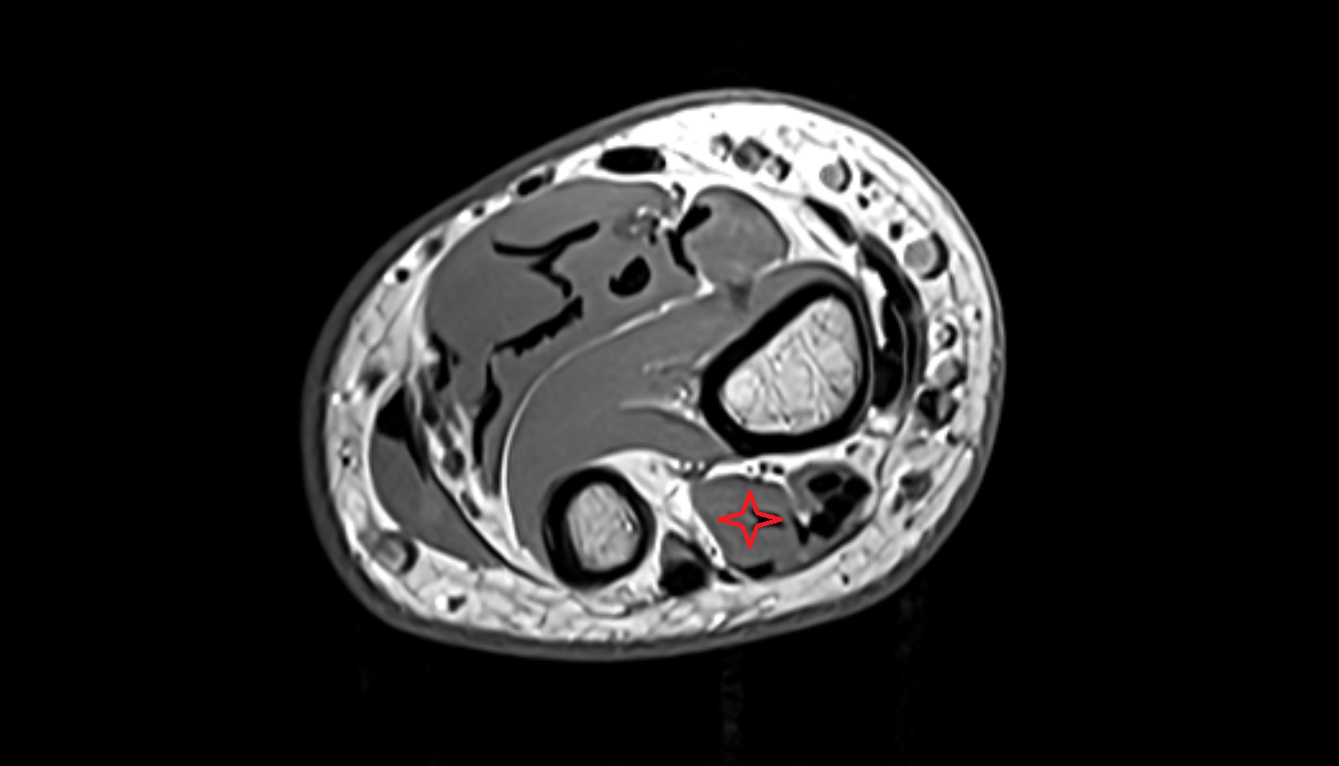 Extensor indicis muscle axial cross sectional anatomy 3T MRI AI enhanced radiology image-img-00000-00000_00001
