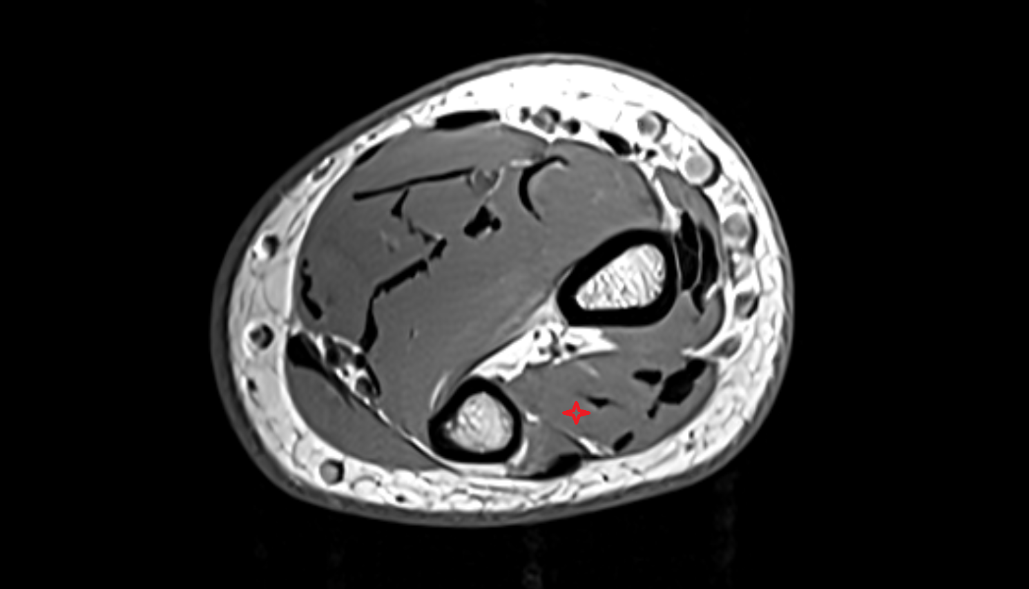 Extensor indicis muscle axial cross sectional anatomy 3T MRI AI enhanced radiology image-img-00000-00000_00002