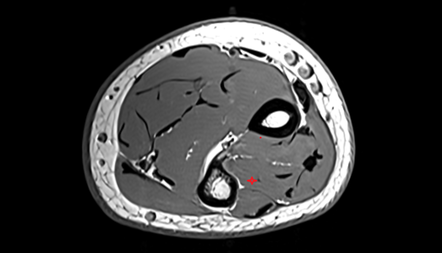 Extensor indicis muscle axial cross sectional anatomy 3T MRI AI enhanced radiology image-img-00000-00000_00003