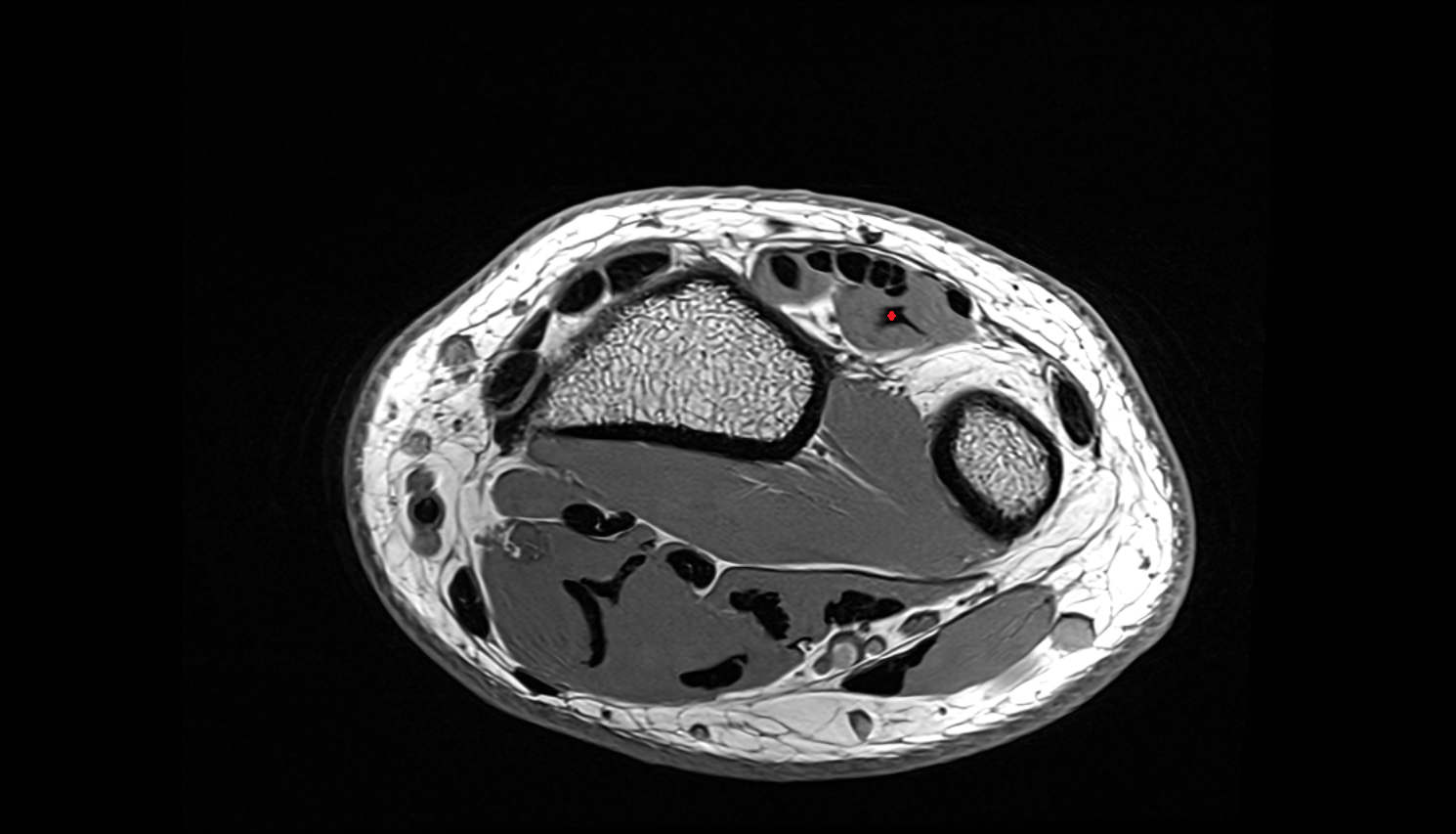 Extensor indicis tendon axial cross sectional anatomy 3T MRI AI enhanced radiology image-img-00000-00000