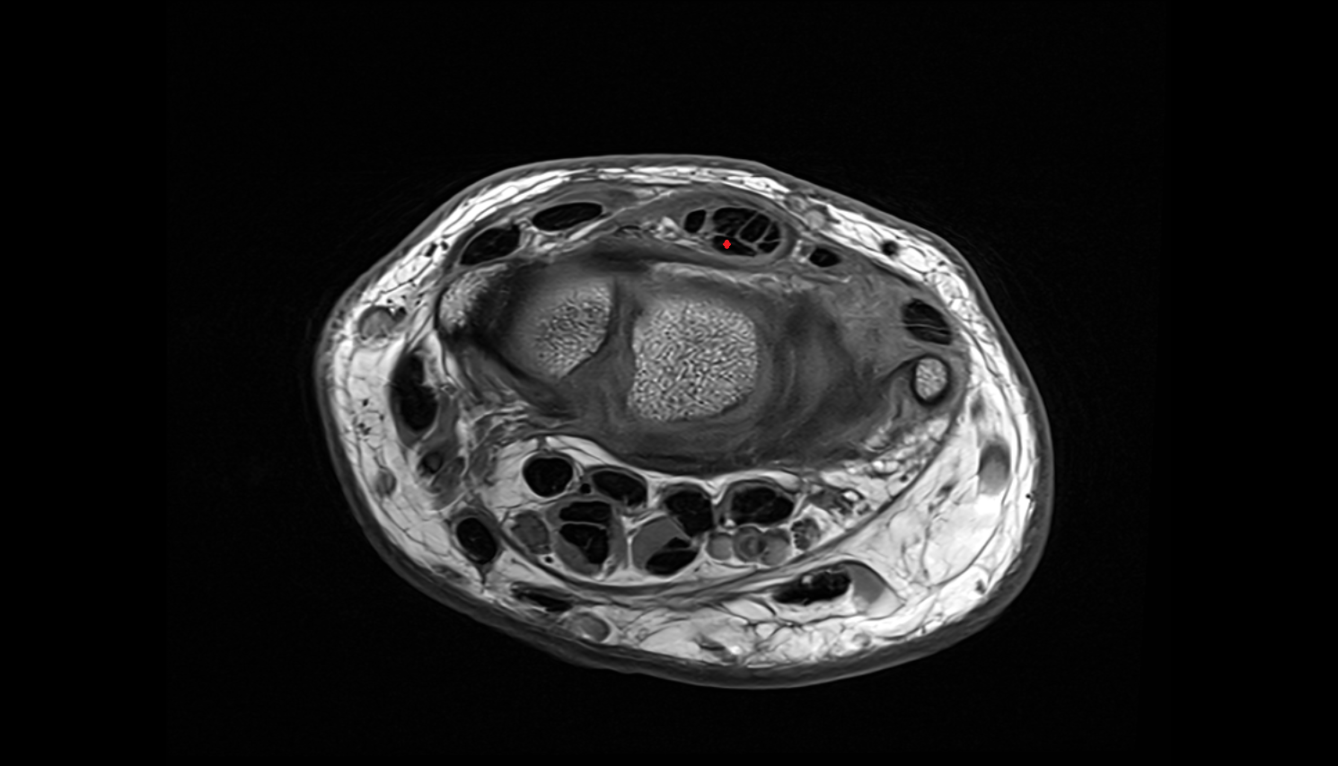 Extensor indicis tendon axial cross sectional anatomy 3T MRI AI enhanced radiology image-img-00000-00000_00001