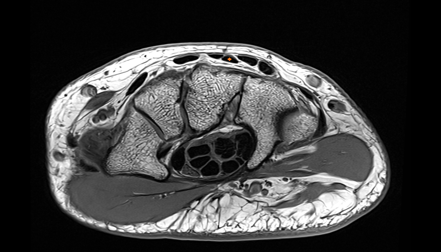 Extensor indicis tendon axial cross sectional anatomy 3T MRI AI enhanced radiology image-img-00000-00000_00002