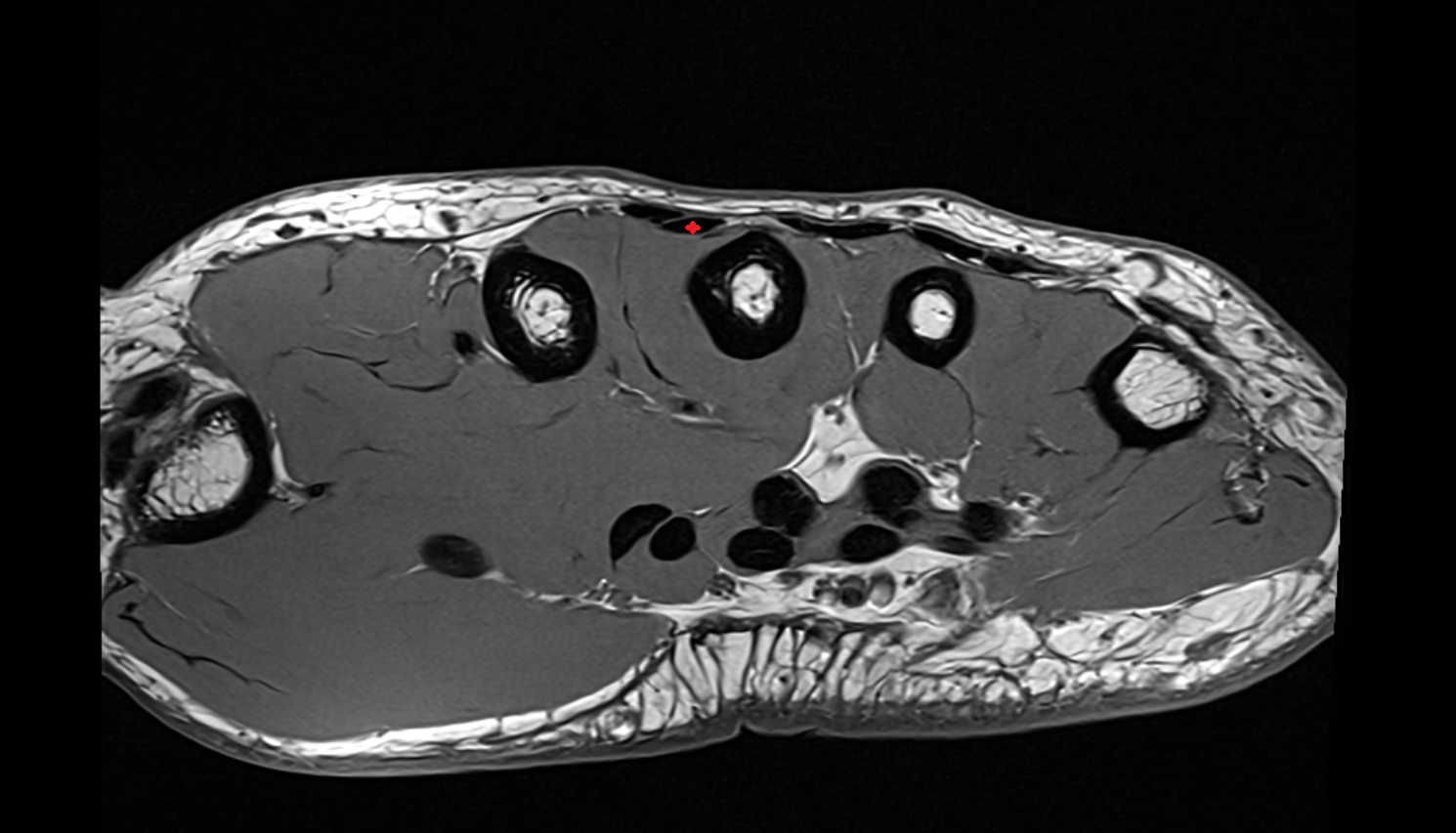 Extensor indicis tendon axial cross sectional anatomy 3T MRI AI enhanced radiology image-img-00000-00000_00003