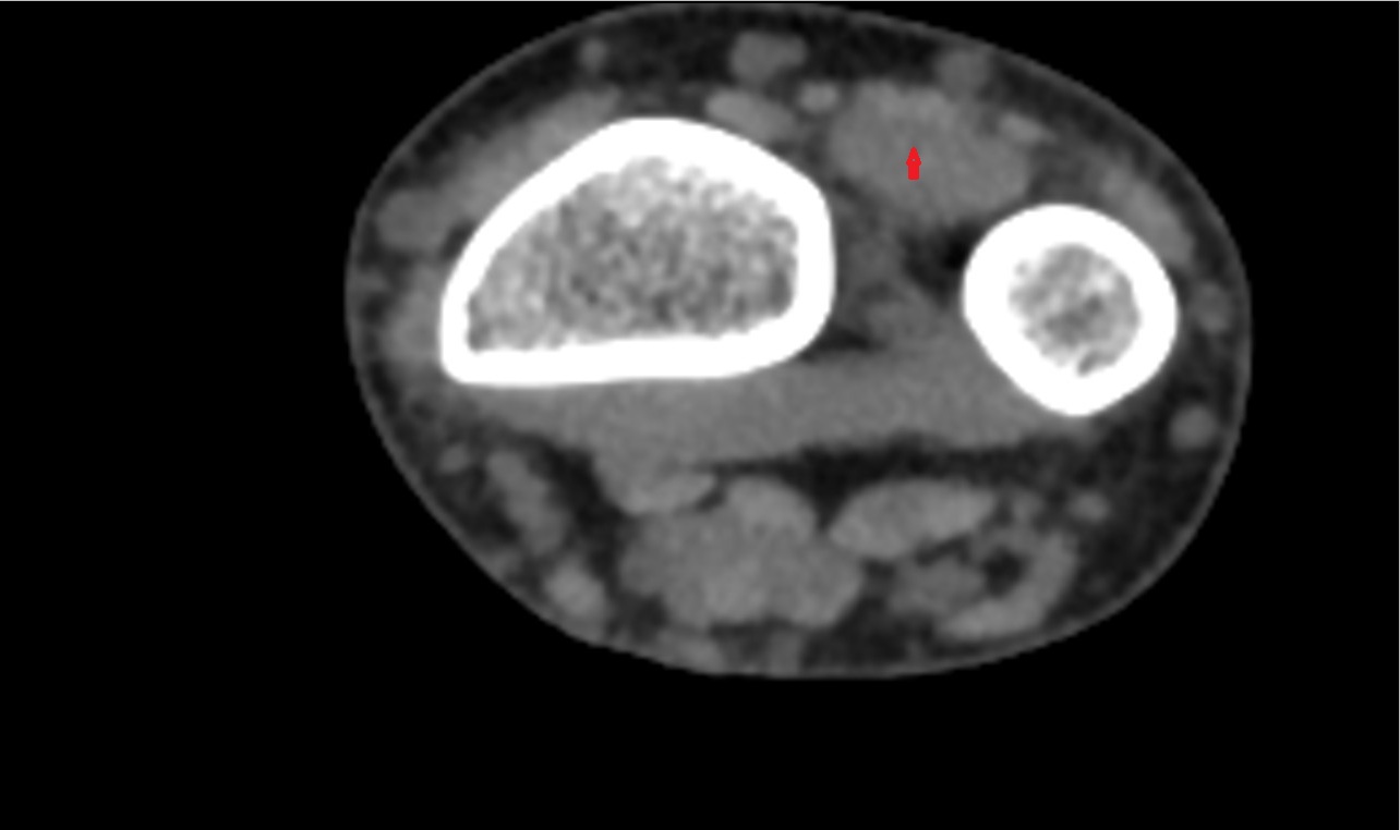 Extensor indicis tendon ct axial