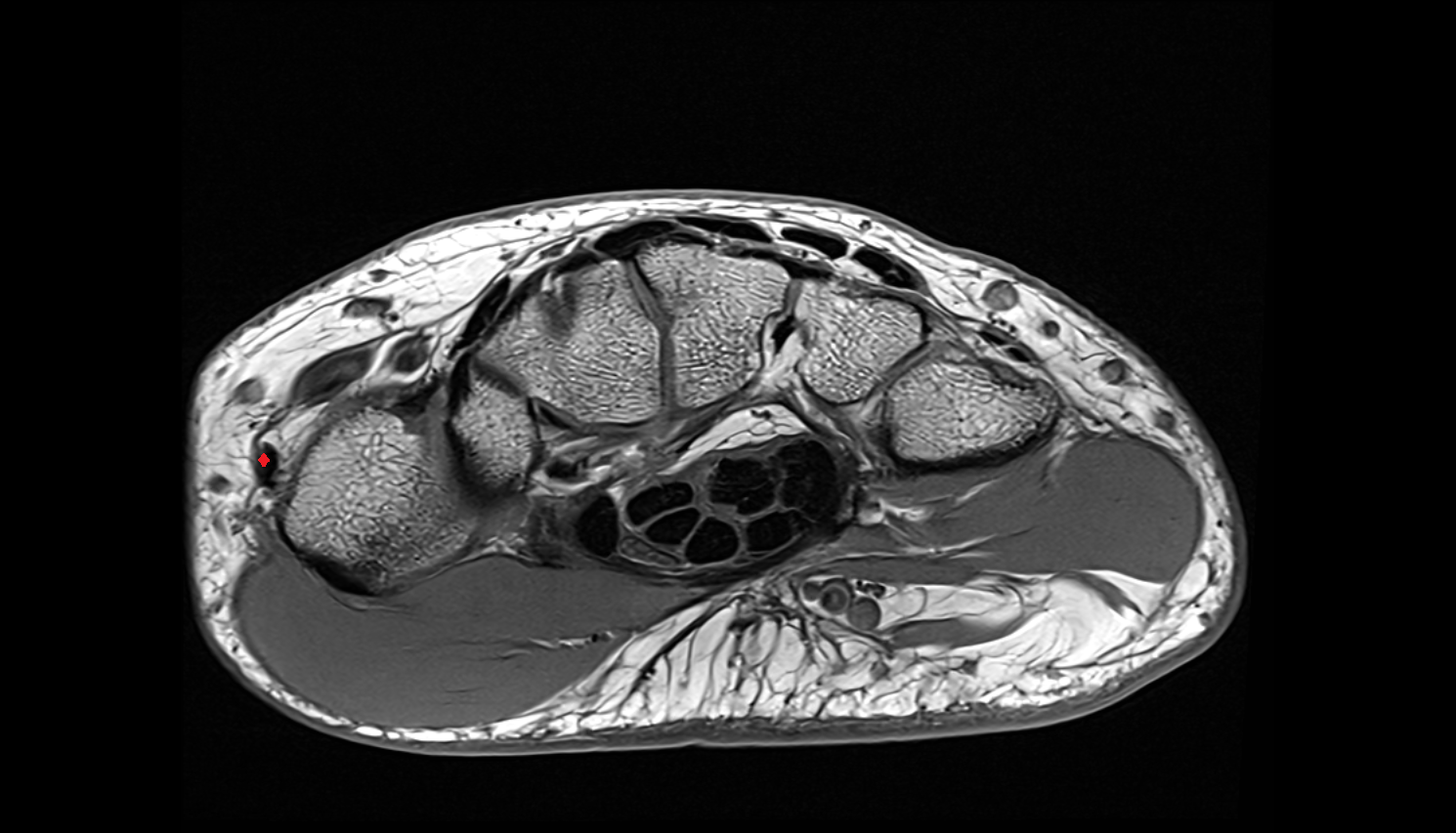 Extensor pollicis brevis tendon axial cross sectional anatomy 3T MRI AI enhanced radiology image-img-00000-00000_00002