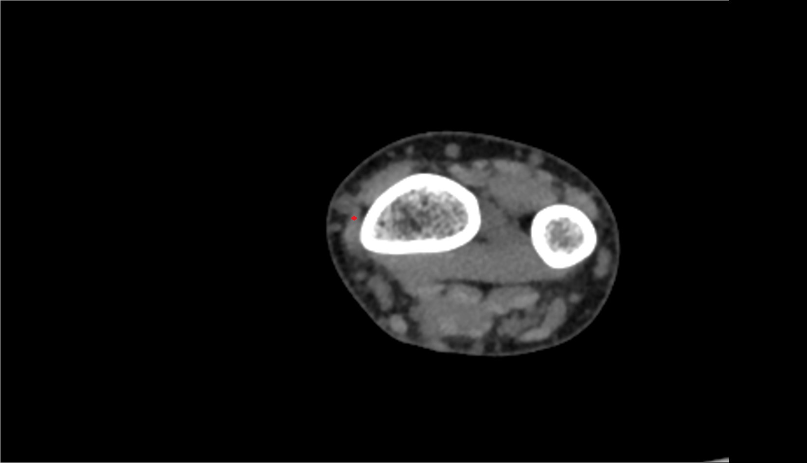 Extensor pollicis brevis tendon ct axial 1
