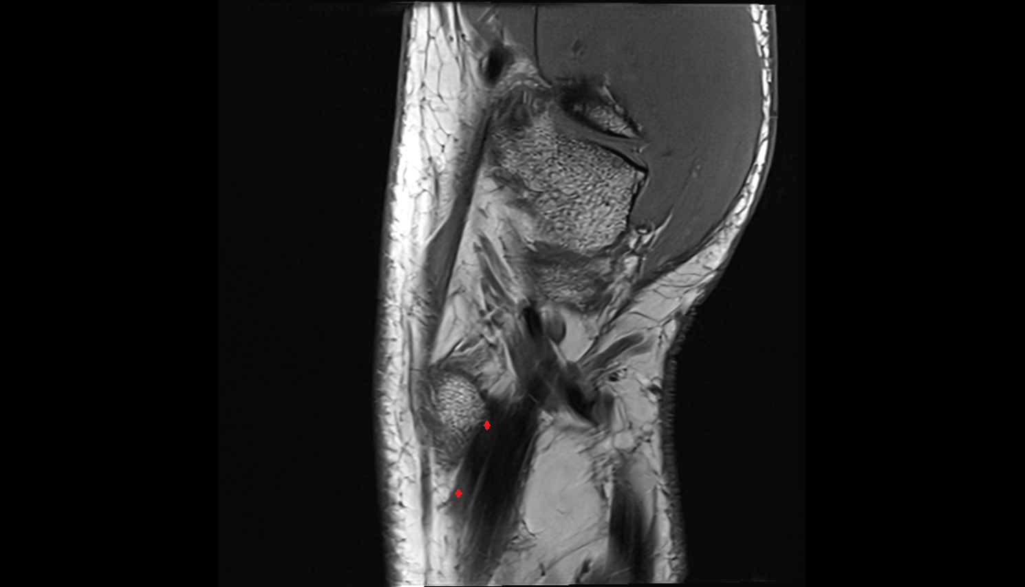 Extensor pollicis brevis tendon sag cross sectional anatomy 3T MRI AI enhanced radiology image-img-00000-00000