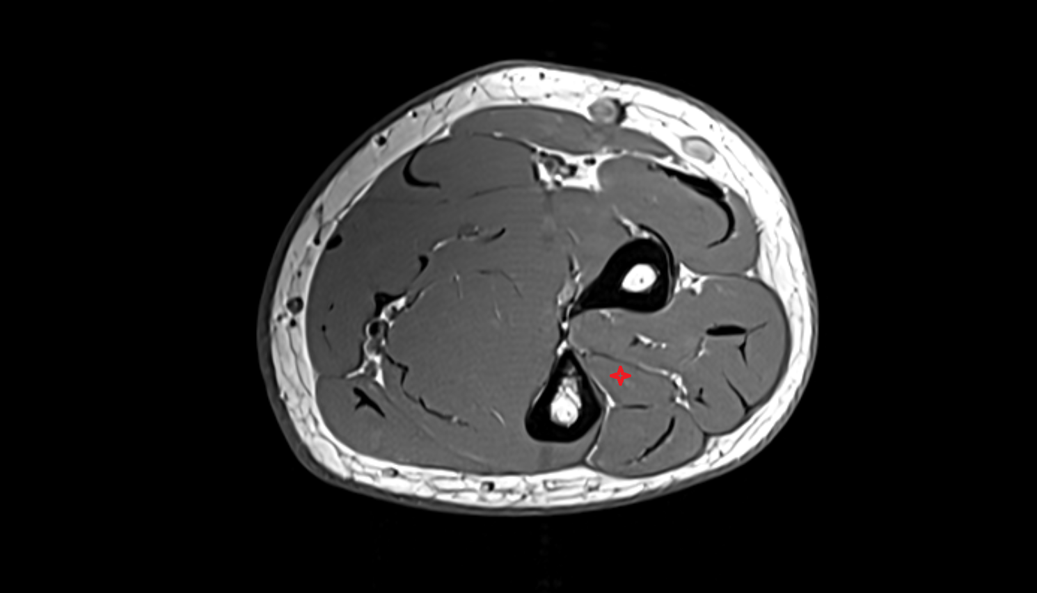 Extensor pollicis longus muscle  axial cross sectional anatomy 3T MRI AI enhanced radiology image-img-00000-00000