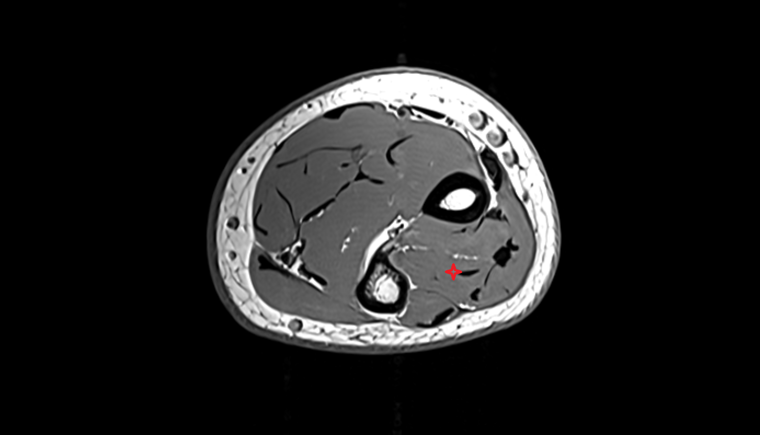 Extensor pollicis longus muscle  axial cross sectional anatomy 3T MRI AI enhanced radiology image-img-00000-00000_00001