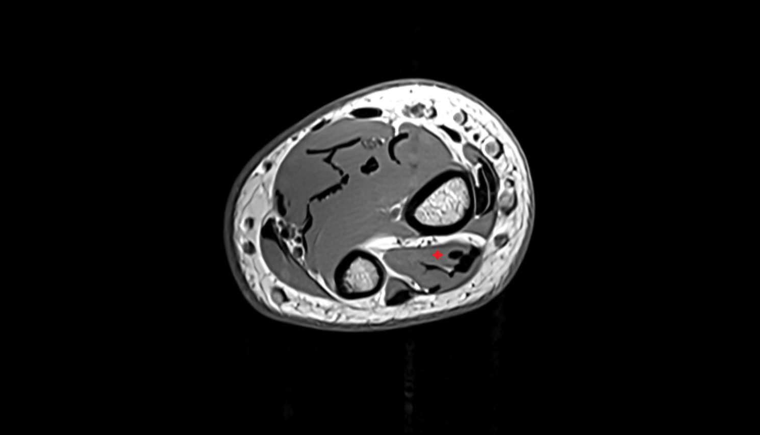 Extensor pollicis longus muscle  axial cross sectional anatomy 3T MRI AI enhanced radiology image-img-00000-00000_00002