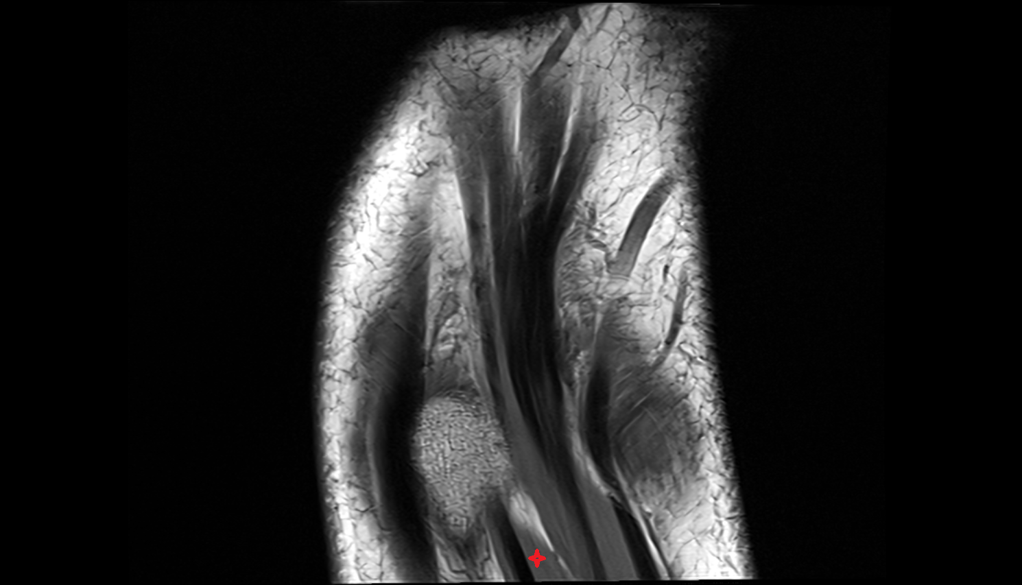 Extensor pollicis longus muscle coronal cross sectional anatomy 3T MRI AI enhanced radiology image-img-00000-00000