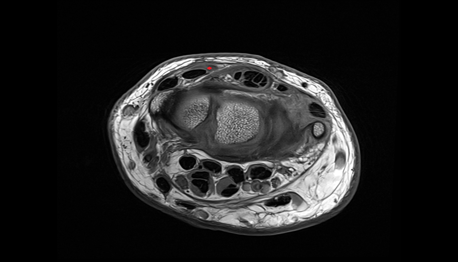 Extensor pollicis longus tendon axial cross sectional anatomy 3T MRI AI enhanced radiology image-img-00000-00000_00001