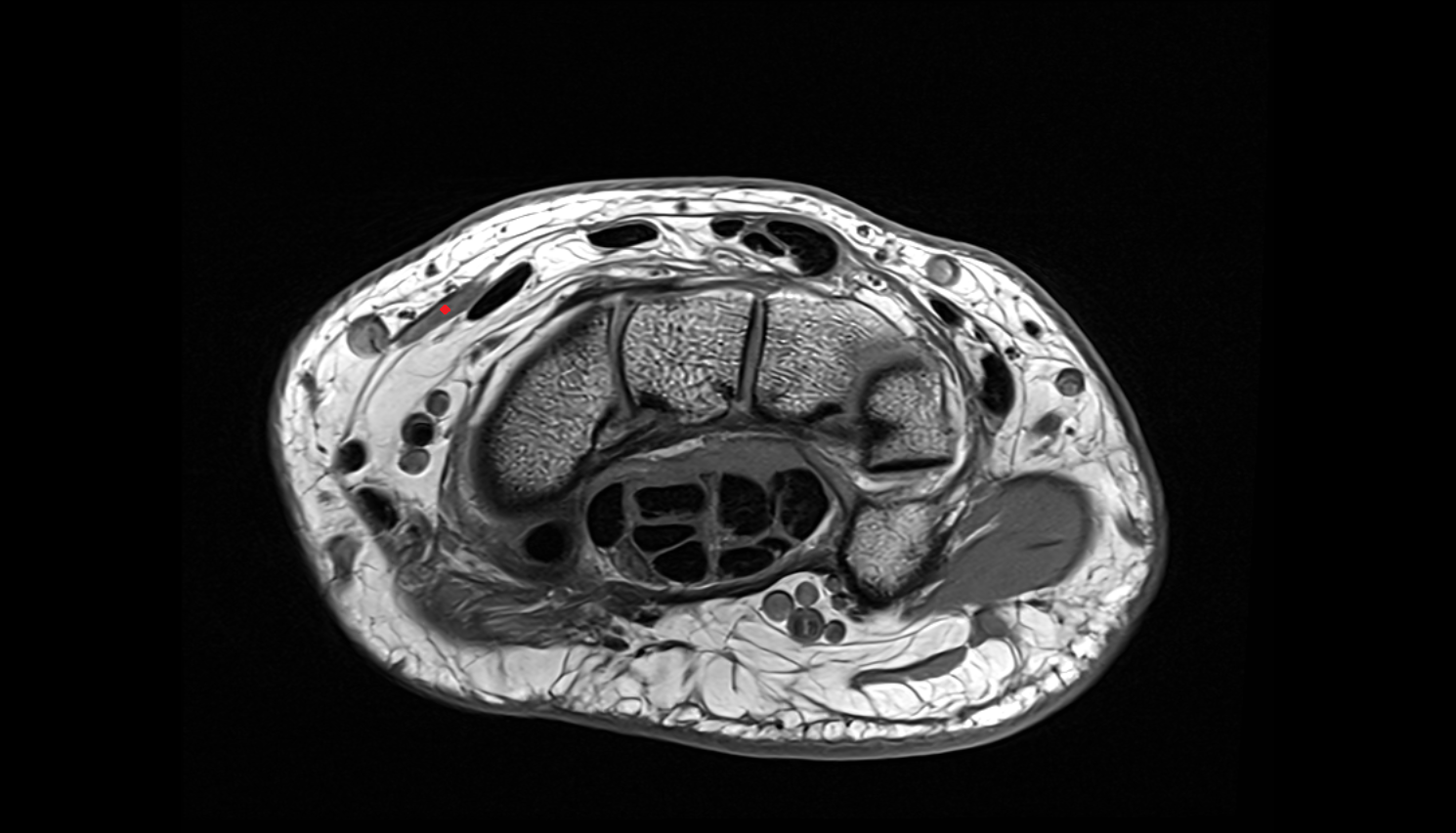 Extensor pollicis longus tendon axial cross sectional anatomy 3T MRI AI enhanced radiology image-img-00000-00000_00002