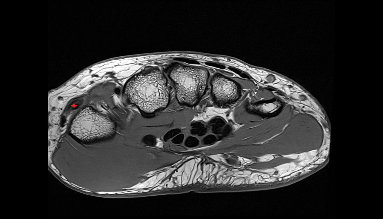 Extensor pollicis longus tendon axial cross sectional anatomy 3T MRI AI enhanced radiology image-img-00000-00000_00003