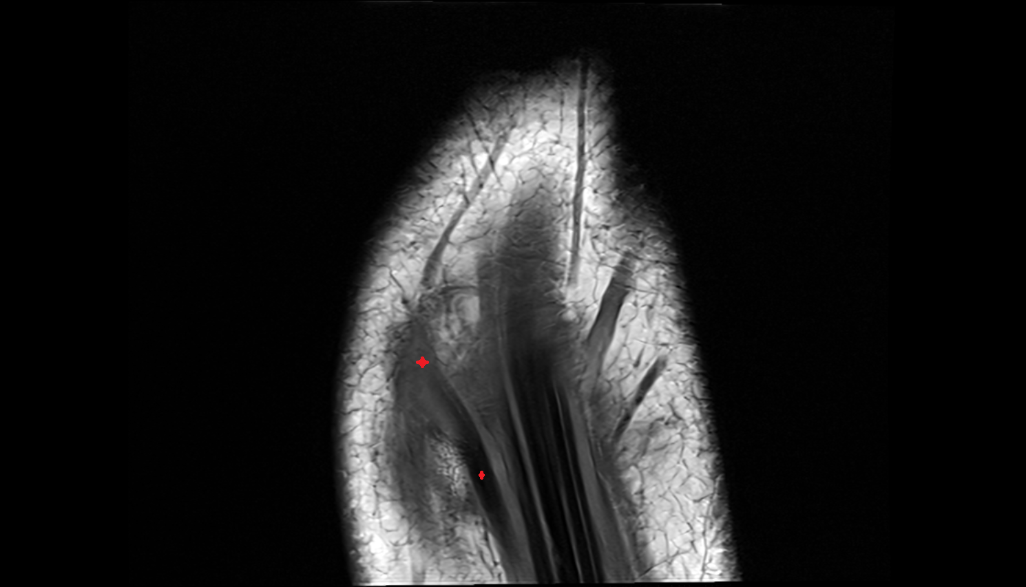 Extensor pollicis longus tendon coronal cross sectional anatomy 3T MRI AI enhanced radiology image-img-00000-00000
