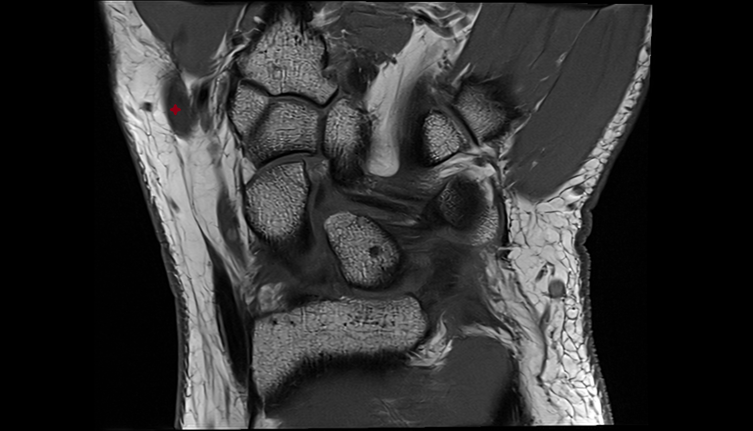 Extensor pollicis longus tendon coronal cross sectional anatomy 3T MRI AI enhanced radiology image-img-00000-00000_00001