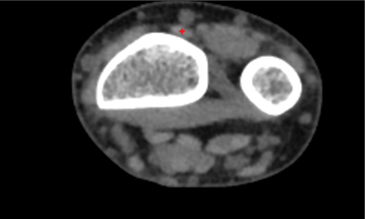 Extensor pollicis longus tendon ct axial 1