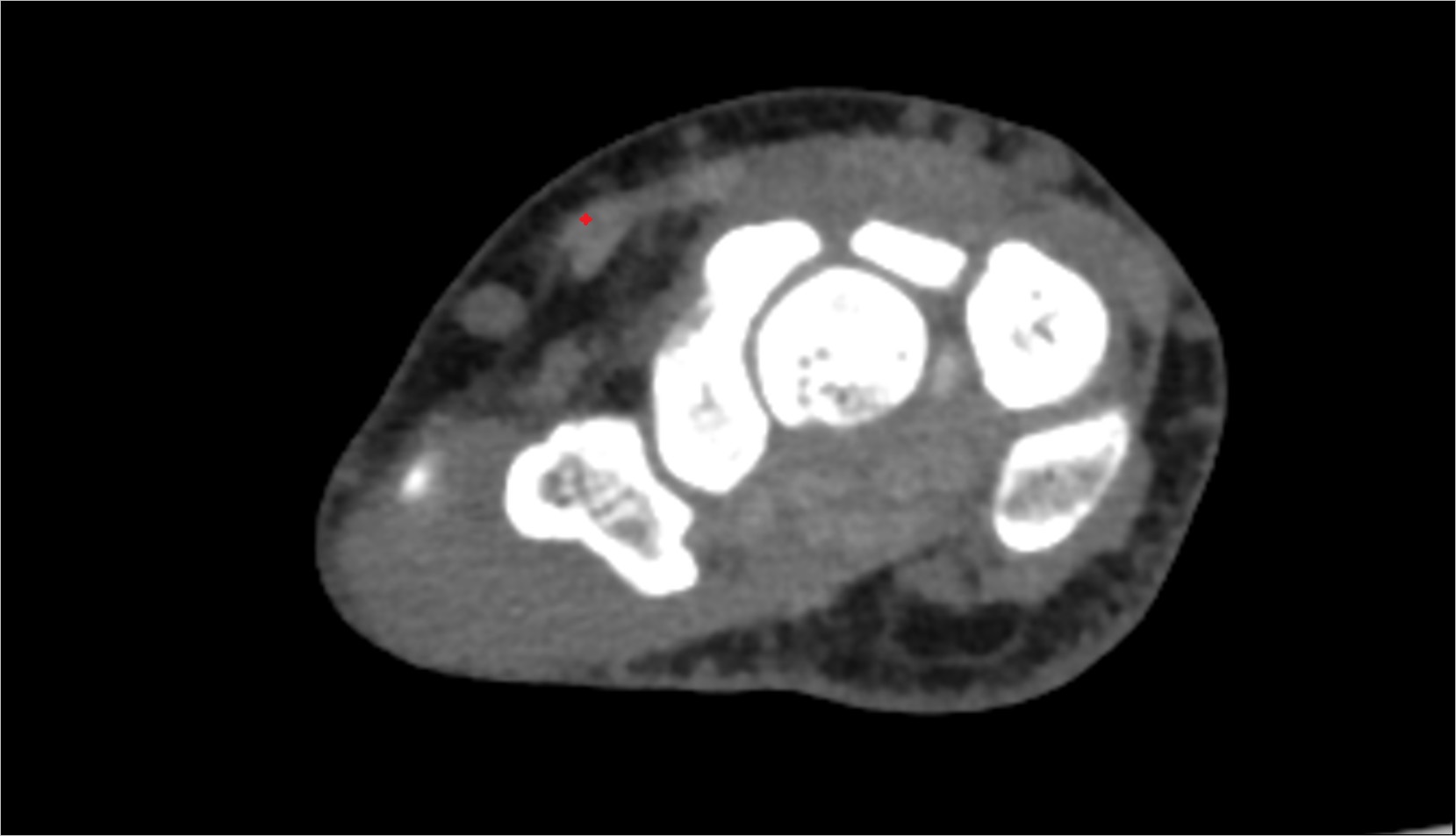 Extensor pollicis longus tendon ct axial 2