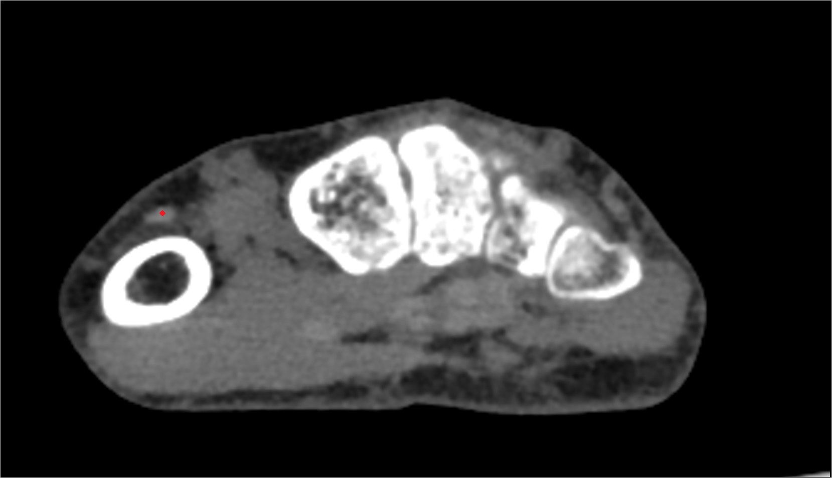 Extensor pollicis longus tendon ct axial 3