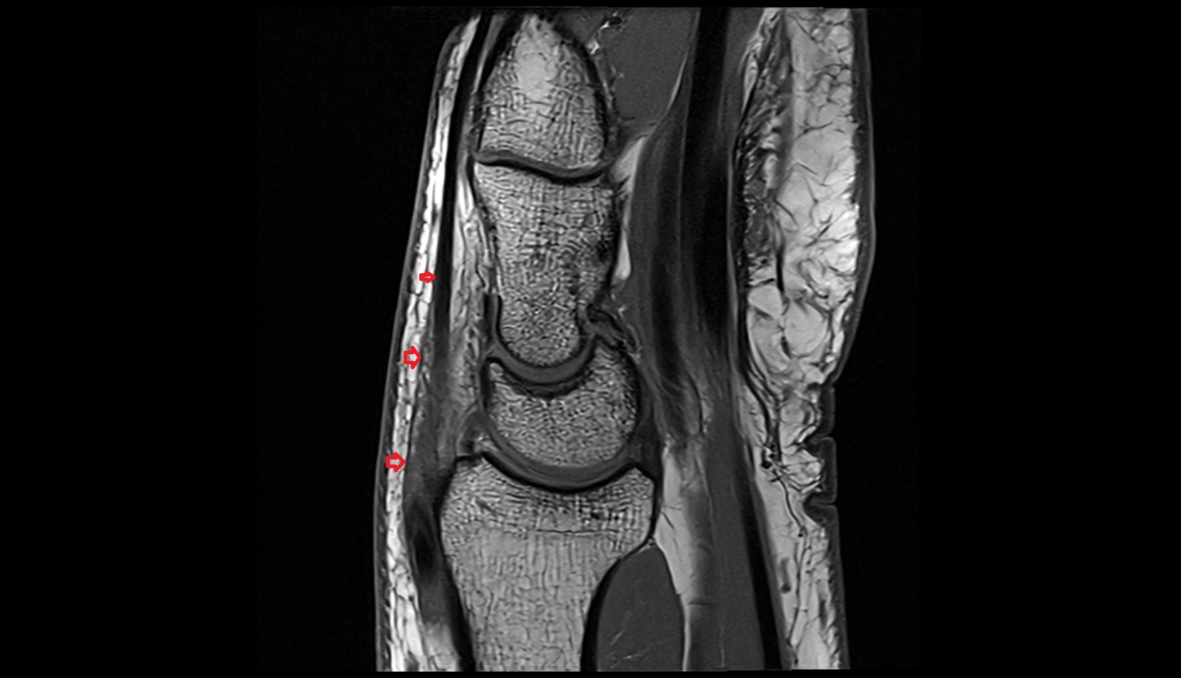 Extensor retinaculum mri sagittal image