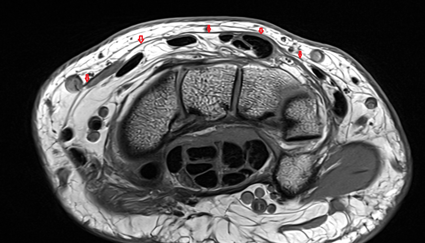 Extensor retinaculum of wrist  axial cross sectional anatomy 3T MRI AI enhanced radiology image-img-00000-00000