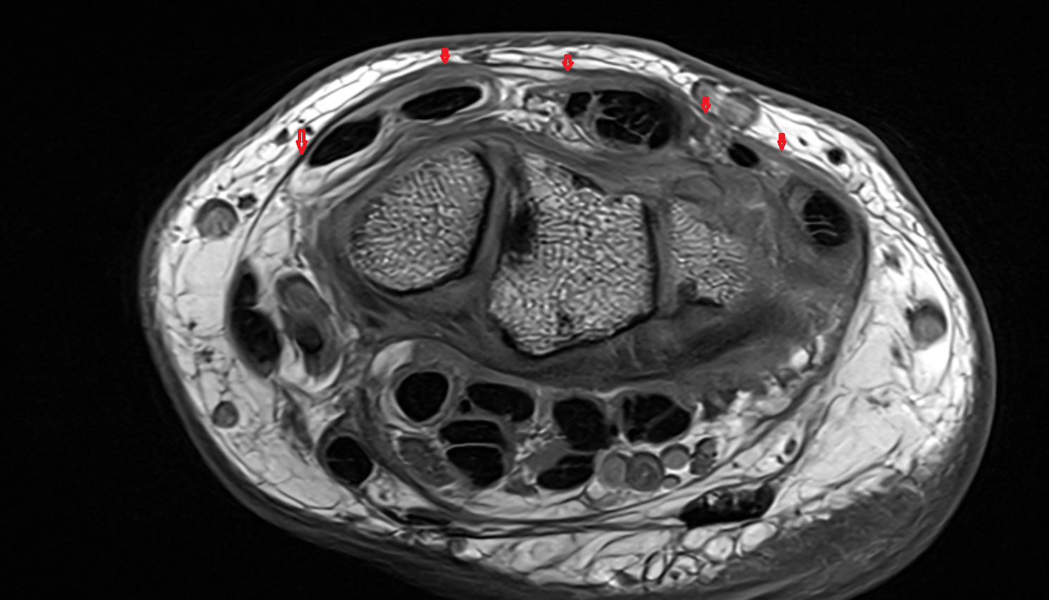 Extensor retinaculum of wrist  axial cross sectional anatomy 3T MRI AI enhanced radiology image-img-00000-00000_00001