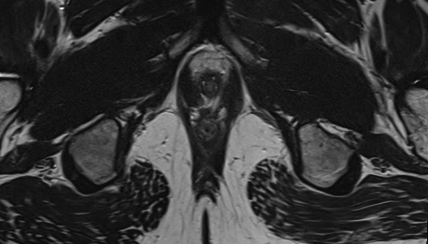 External Urethral Sphincter (Male)   MRI  axial  anatomy  image-img-00000-00000