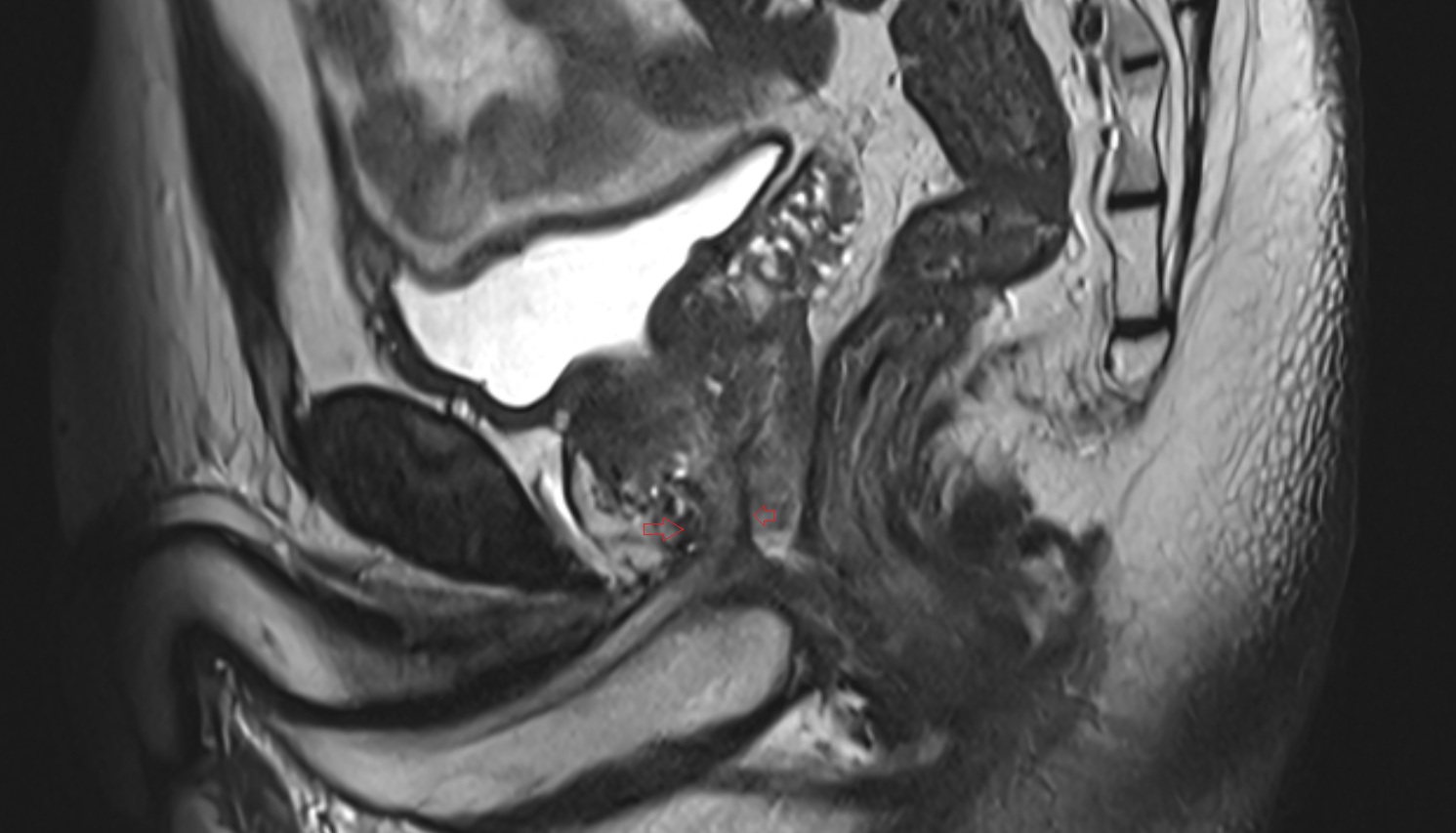 External Urethral Sphincter (Male)   MRI  sag  anatomy  image-img-00000-00000