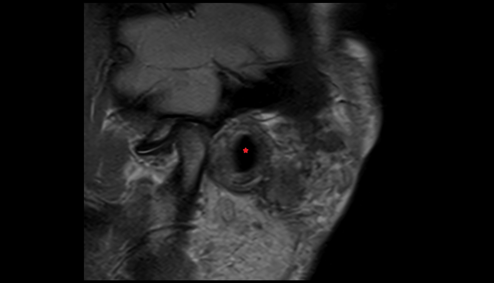 External acoustic meatus