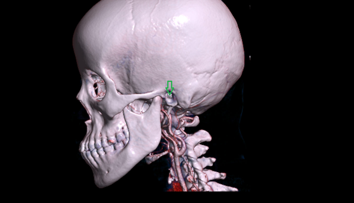 External acoustic meatus CT 3d anatomy labelled image-img-00000-00000