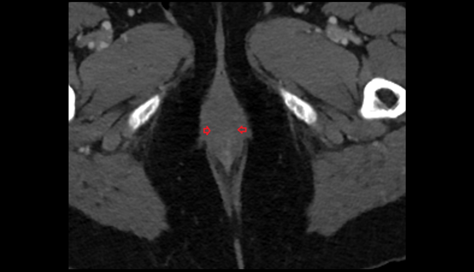 External anal sphincter muscle CT axial image
