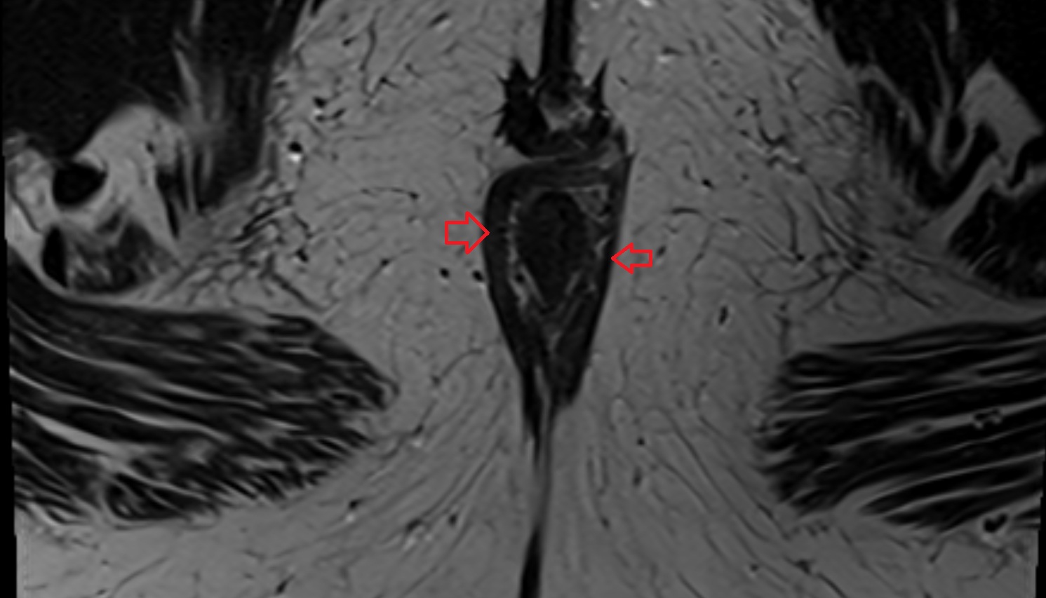 External anal sphincter muscle MRI  axial  anatomy  image-img-00000-00000