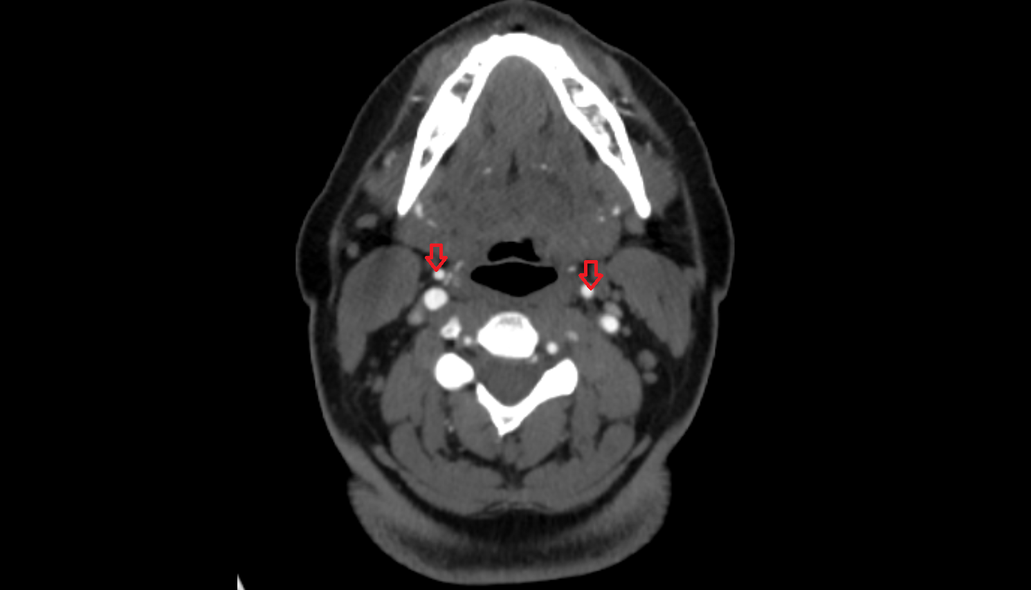 External carotid artery CT axial  image-img-00000-00000