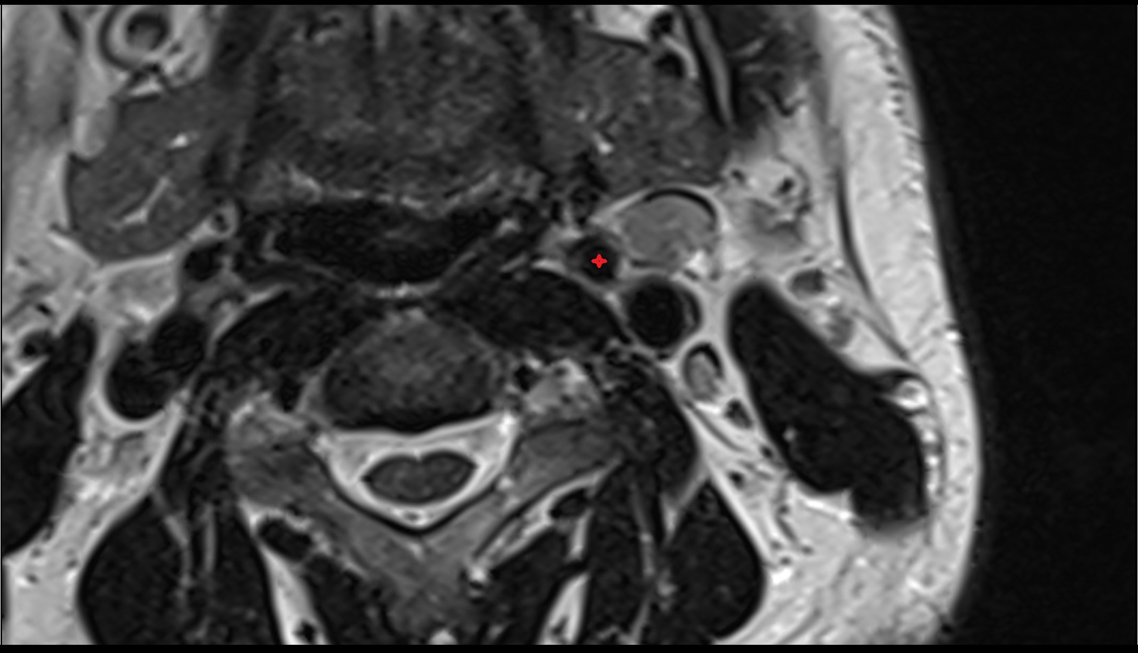 External carotid artery mri axial t2 image