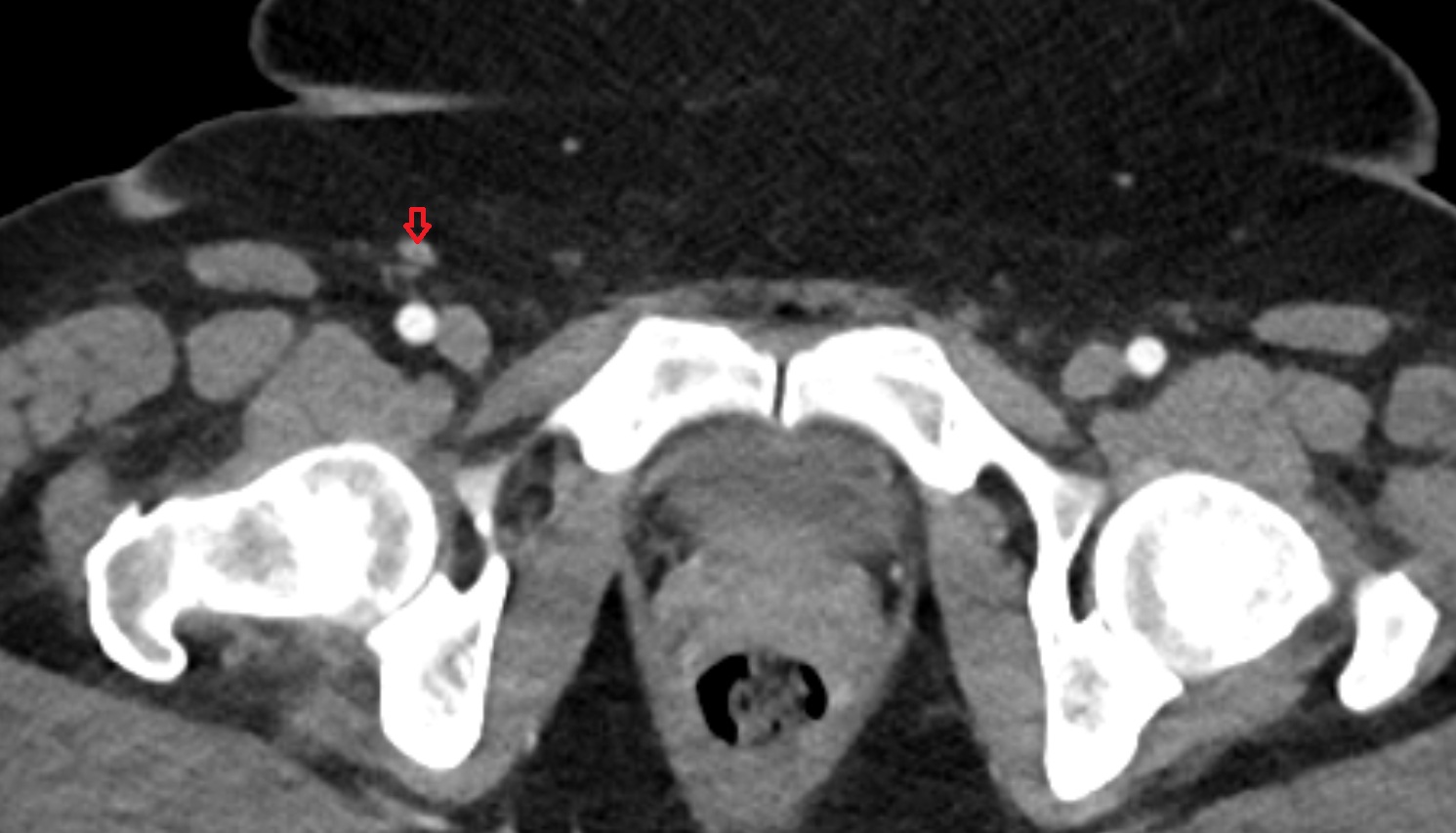 External iliac lymph nodes  CT  axial  anatomy  image-img-00000-00000
