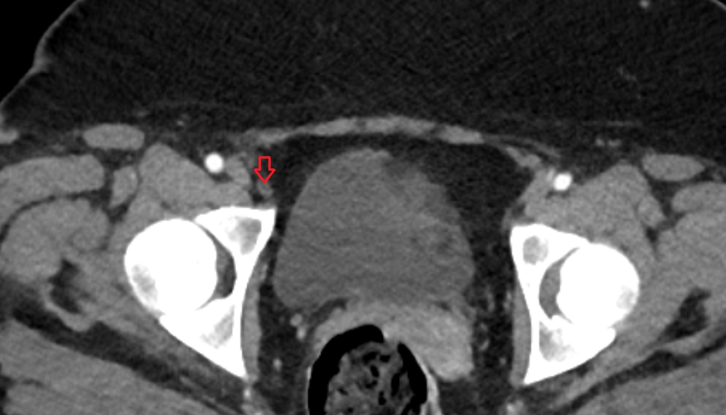External iliac lymph nodes  CT  axial  anatomy  image-img-00000-00000_00001
