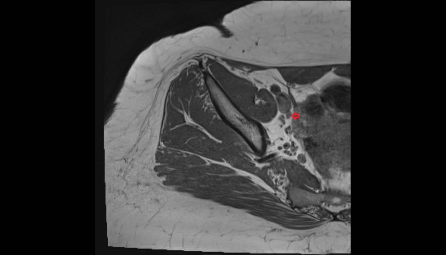 External iliac lymph nodes  MRI  axial  anatomy  image-img-00000-00000_00001