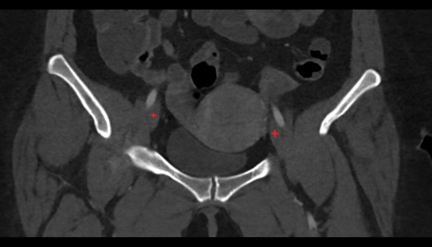 External iliac vein ct coronal   anatomy image-img-00000-00000