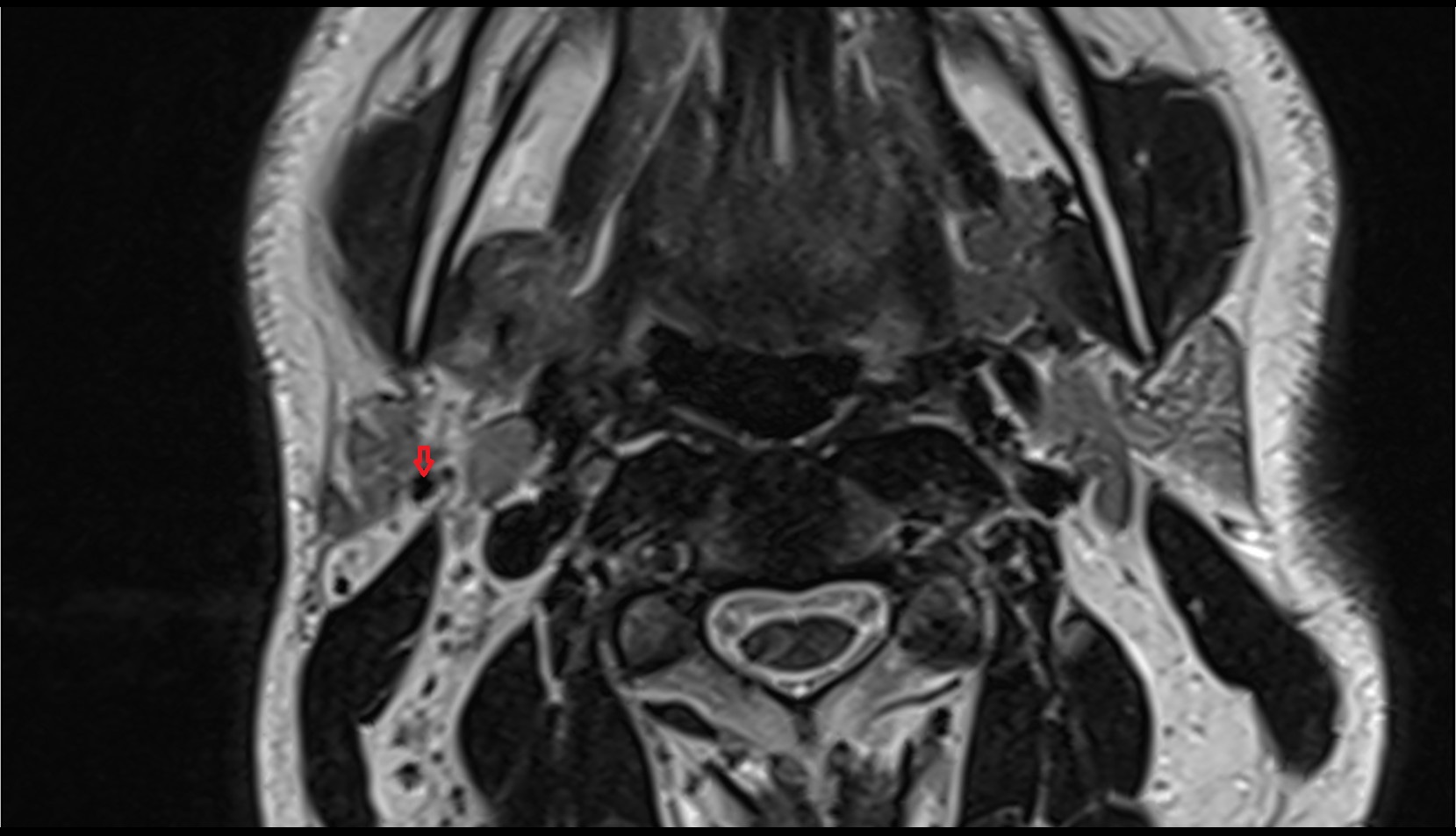 External jugular vein axial mri image