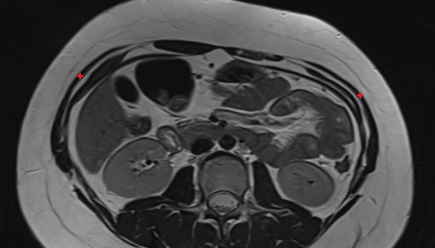 External oblique muscle  anatomy MRI axial  image -img-00000-00000