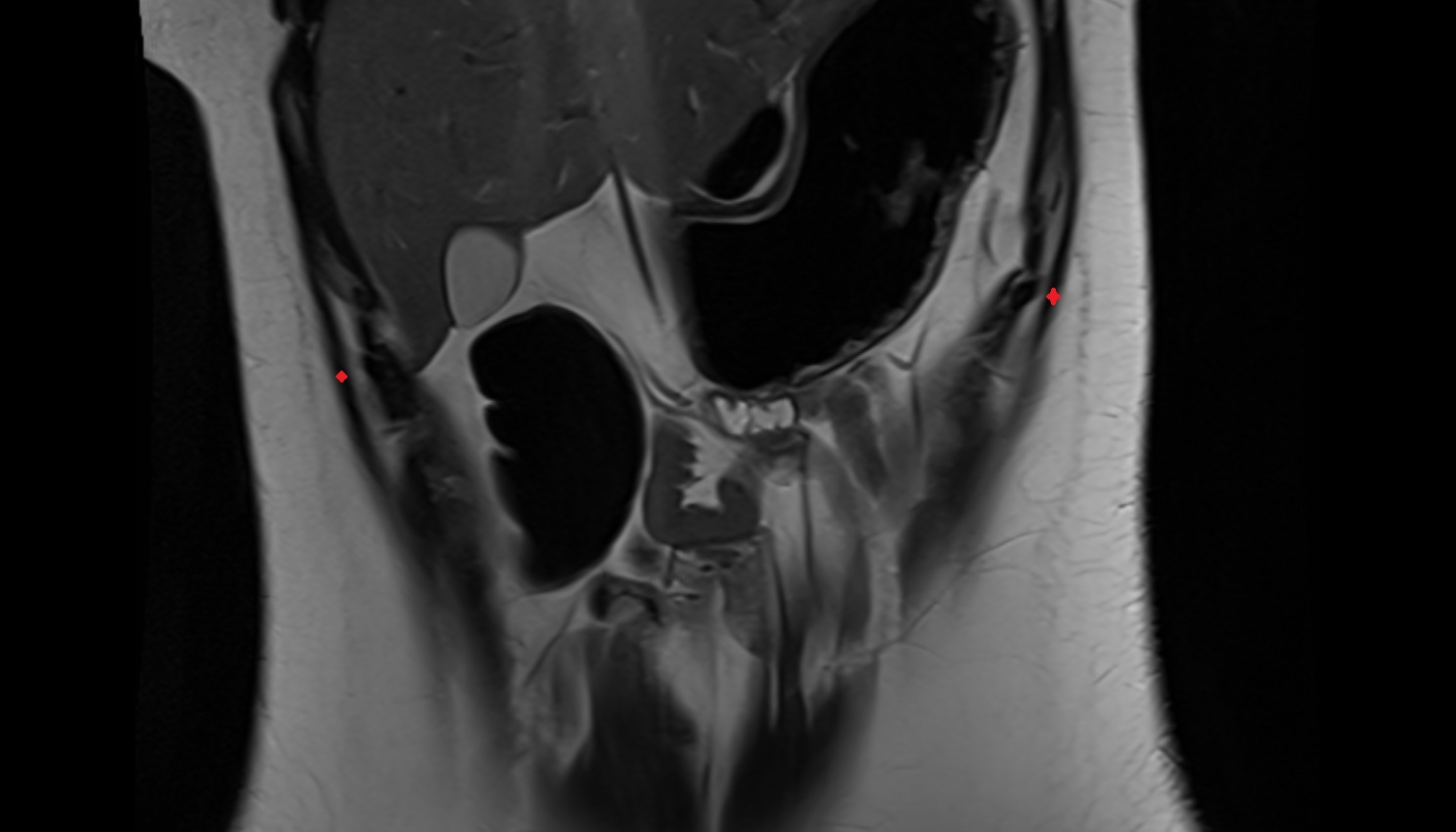 External oblique muscle  anatomy MRI coronal  image -img-00000-00000