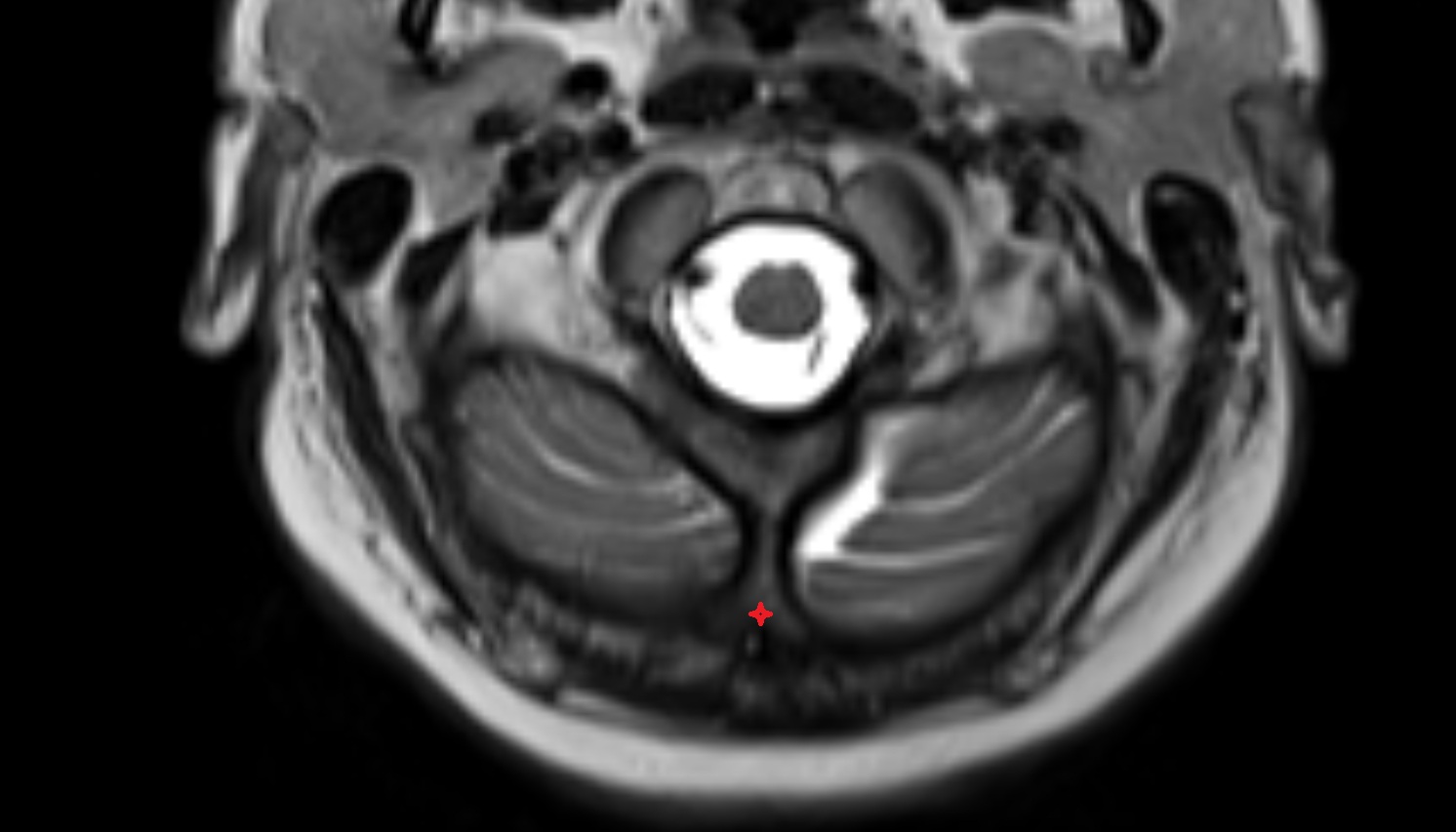 External occipital protuberance mri axial image -img-00000-00000