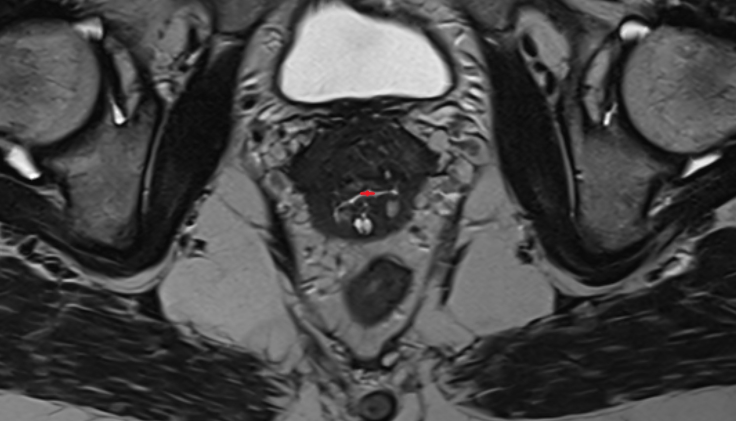 External os of the cervix  MRI   AXIAL  anatomy  image-img-00000-00000_00001