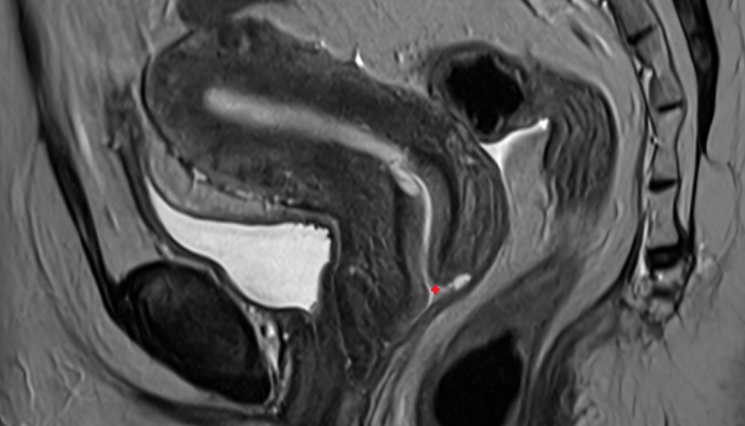 External os of the cervix  MRI   sagittal  anatomy  image-img-00000-00000