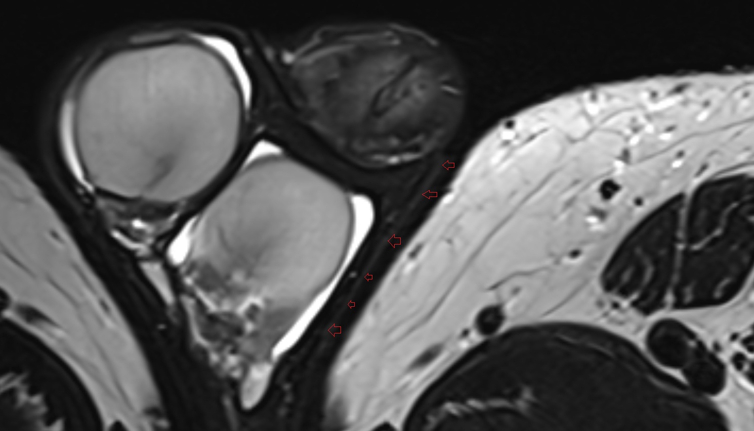 External spermatic fascia  mri axial  anatomy  image-img-00000-00000_00001
