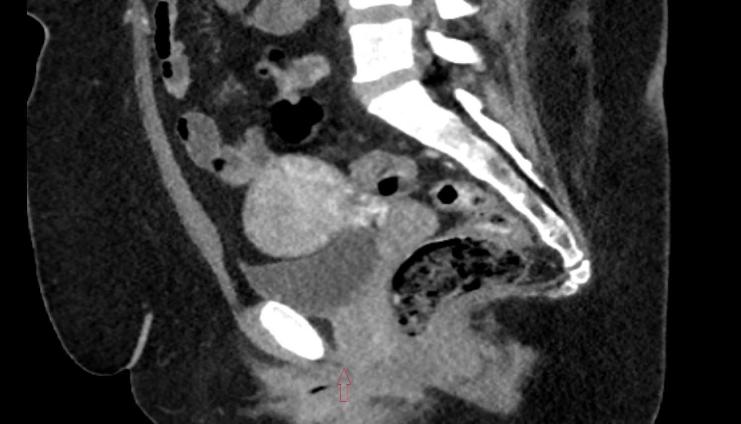 External urethral orifice  CT  sagittal anatomy  image-img-00000-00000