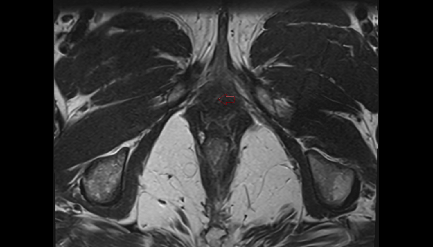 External urethral orifice  MRI axial anatomy  image-img-00000-00000