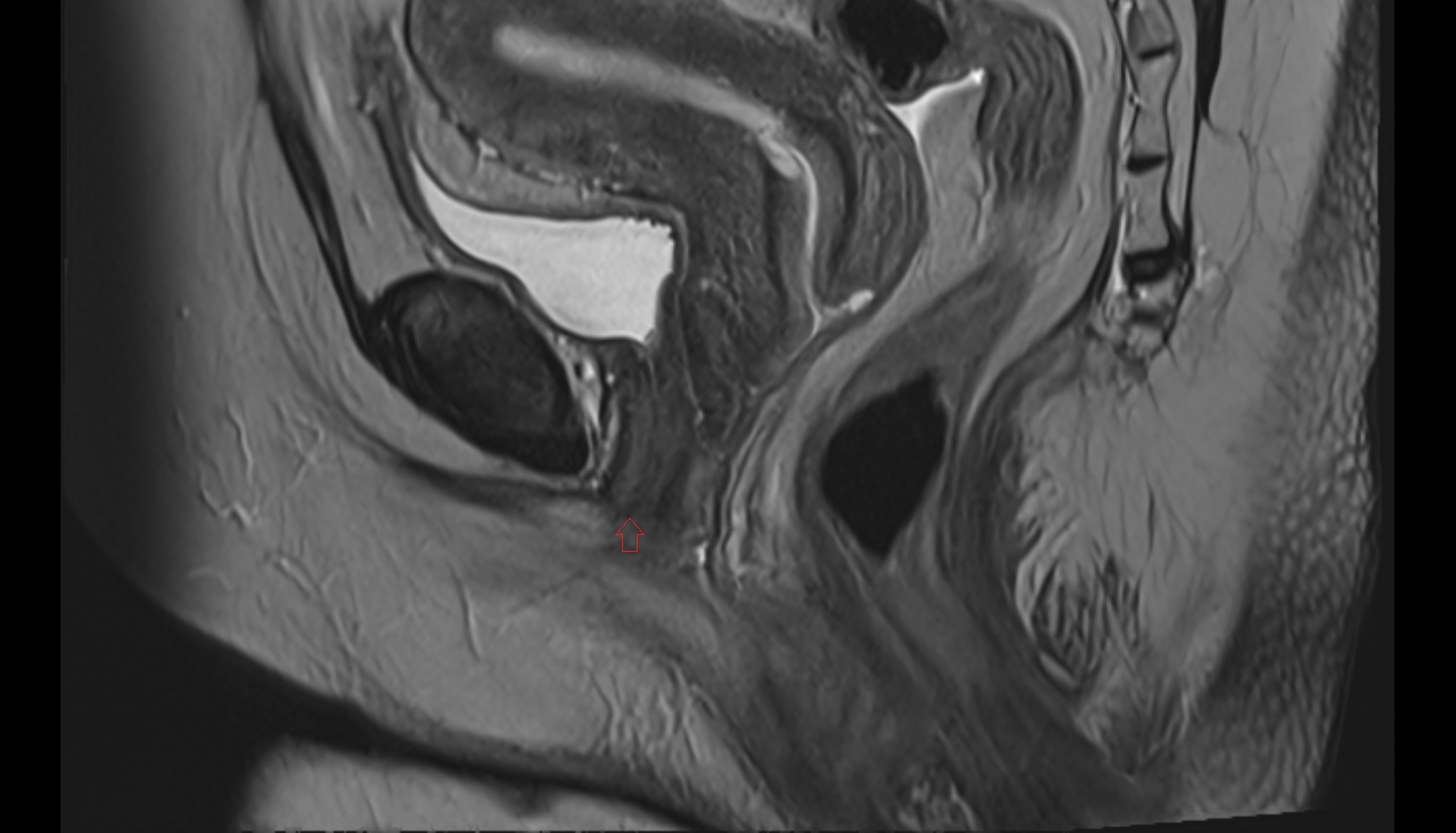 External urethral orifice  MRI  sagittal anatomy  image-img-00000-00000
