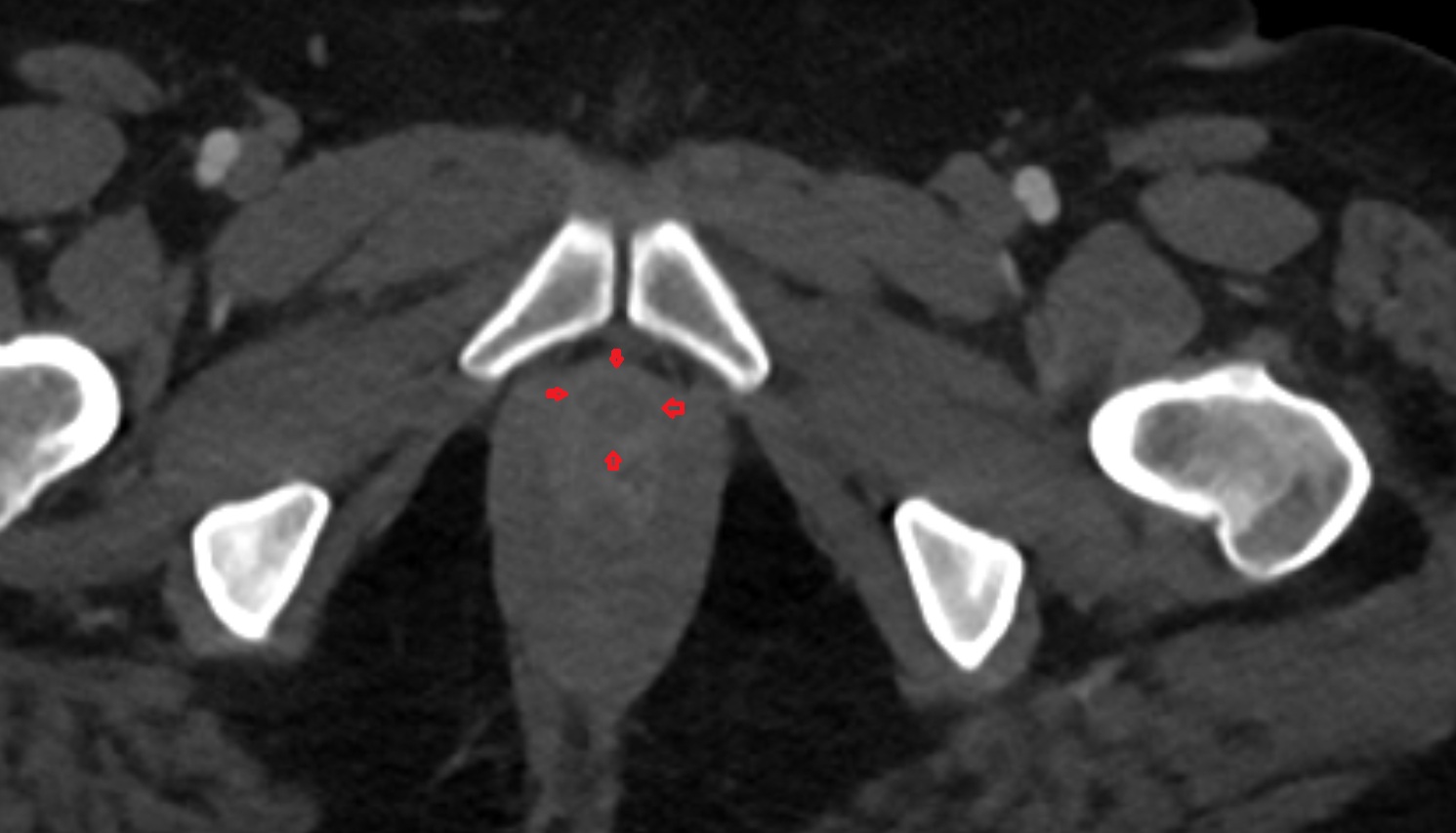 External urethral sphincter female  CT axial  anatomy  image-img-00000-00000