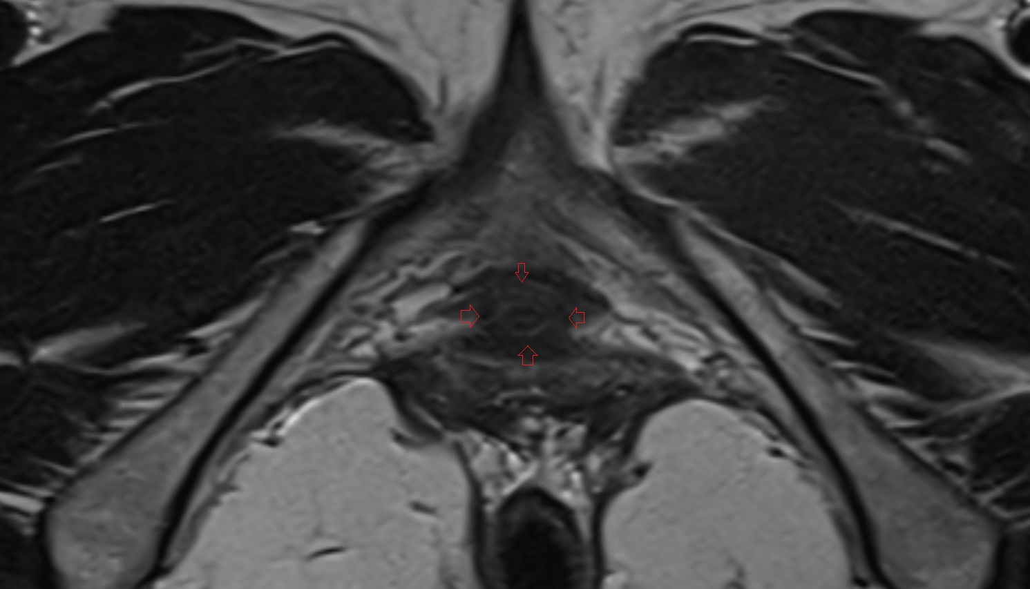 External urethral sphincter female  mri  axial  anatomy  image-img-00000-00000